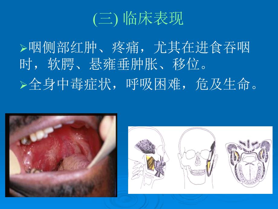 八咽旁间隙parapharyngealspace感染_第3页