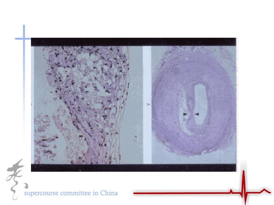 大脉管病炎症在糖尿病中作用_第3页