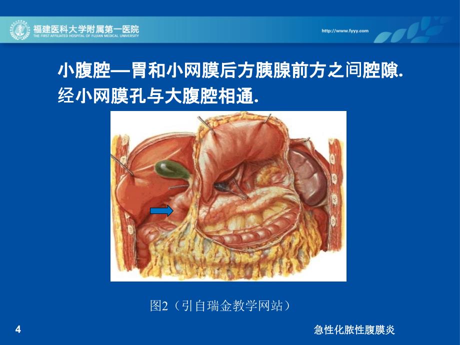 急性化脓性腹膜炎培训课件_第4页