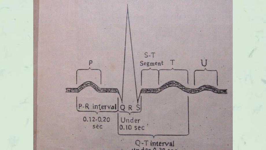 常见心电图诊断最新课件_第3页