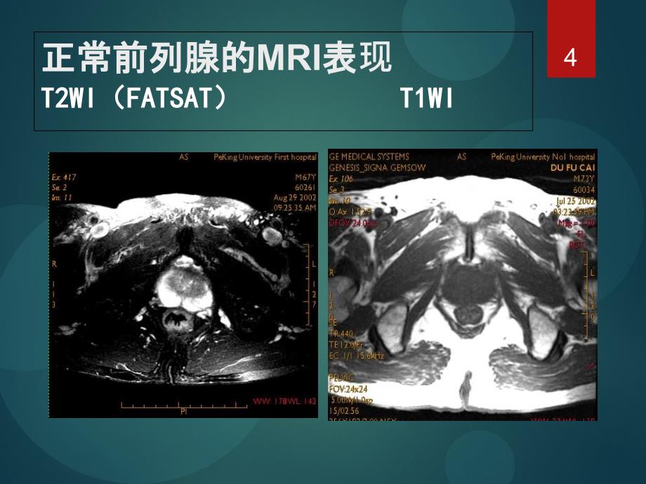 前列腺癌MRI的检查与诊断共识_第4页