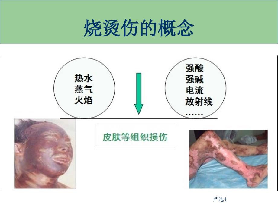 烧烫伤急救处理【医学技术】_第2页