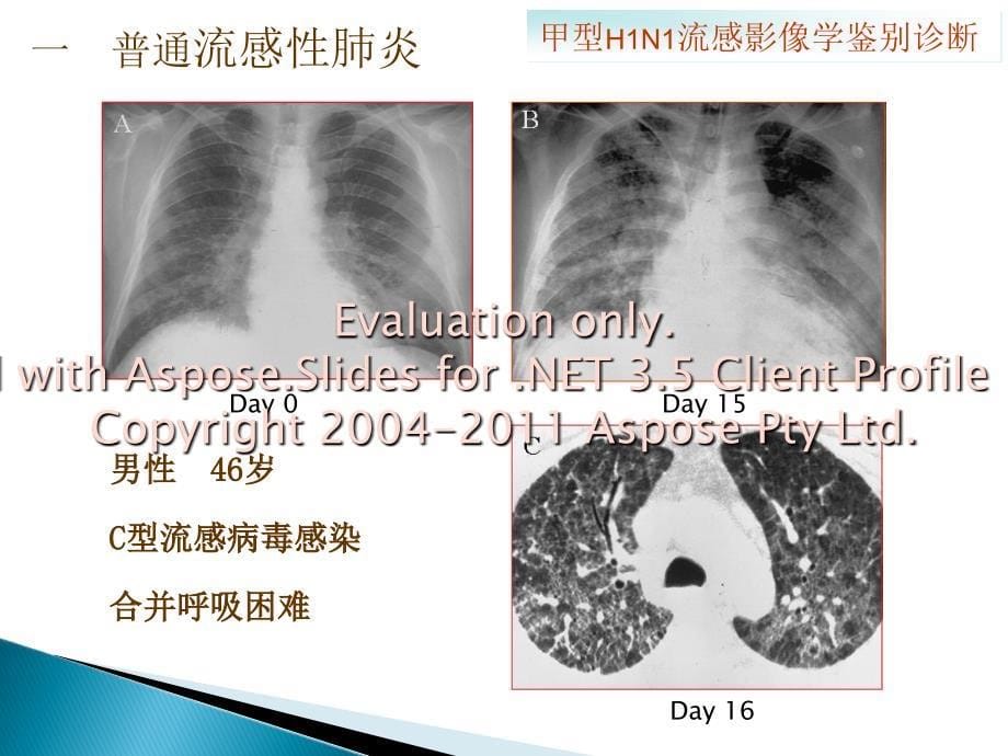 甲型H1N1流感的影像学鉴别诊断_第5页