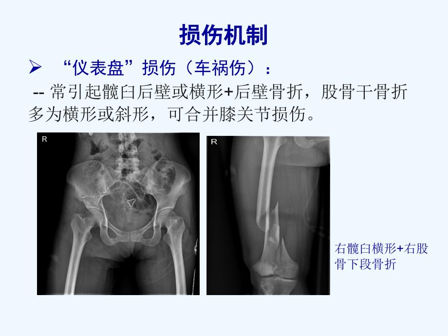 浮髋损伤（65页）教学课件_第3页