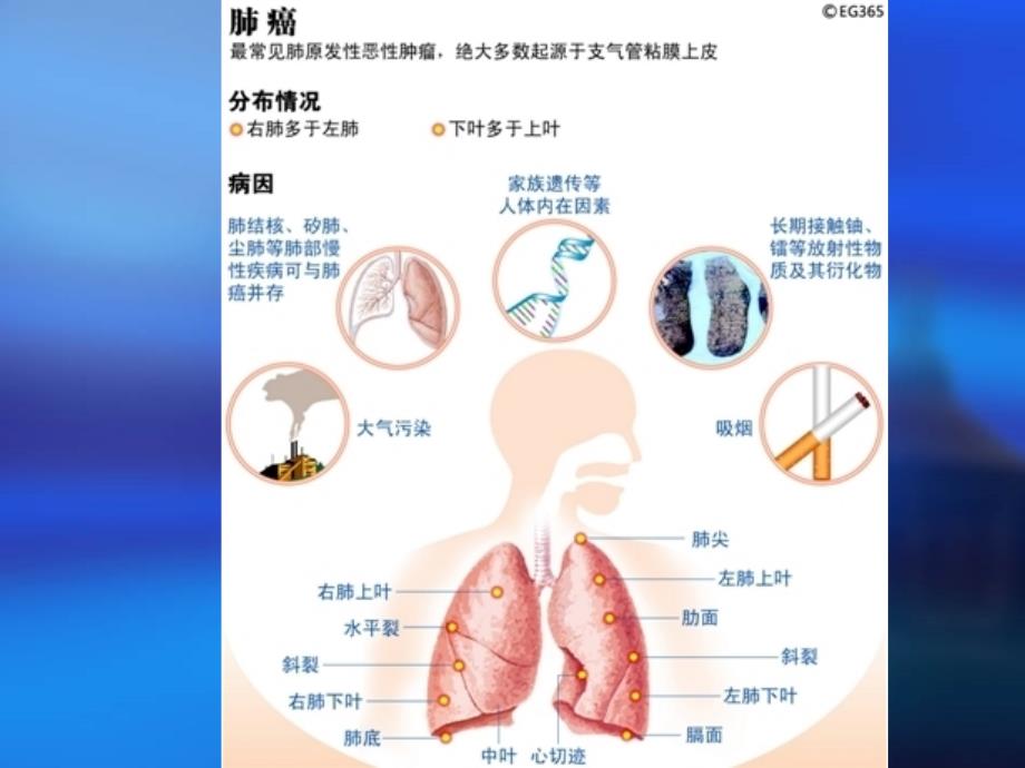 支气管肺癌的护理_第4页