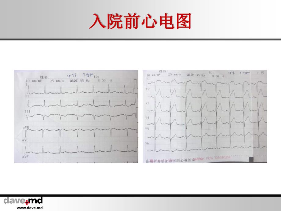 急诊PCI术中非罪犯血管闭塞1例_第4页