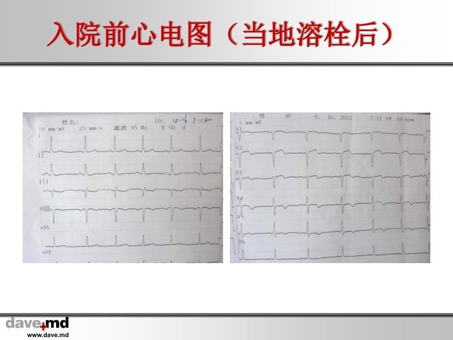 急诊PCI术中非罪犯血管闭塞1例_第5页