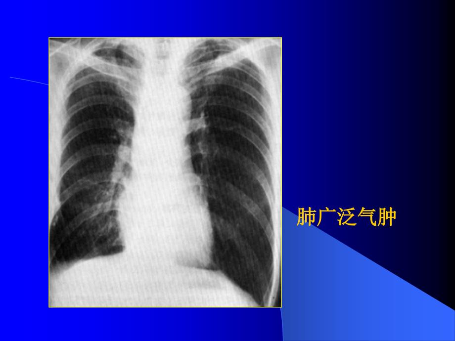 肺部基本病变影象像表现_第4页