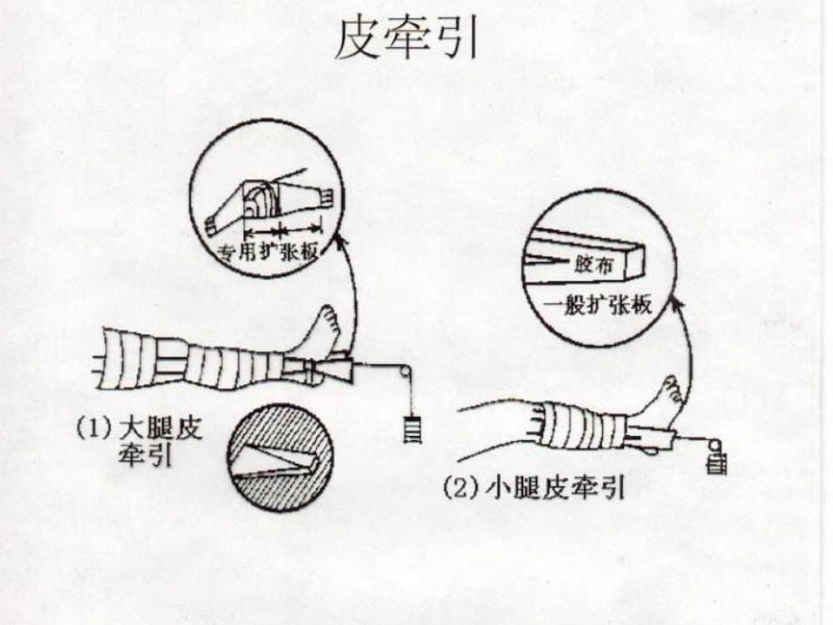 骨科牵引病人的护理要点_第5页