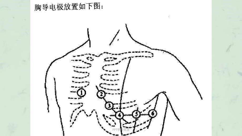 急诊常见异常心电图及抢救应对ppt课件_第5页