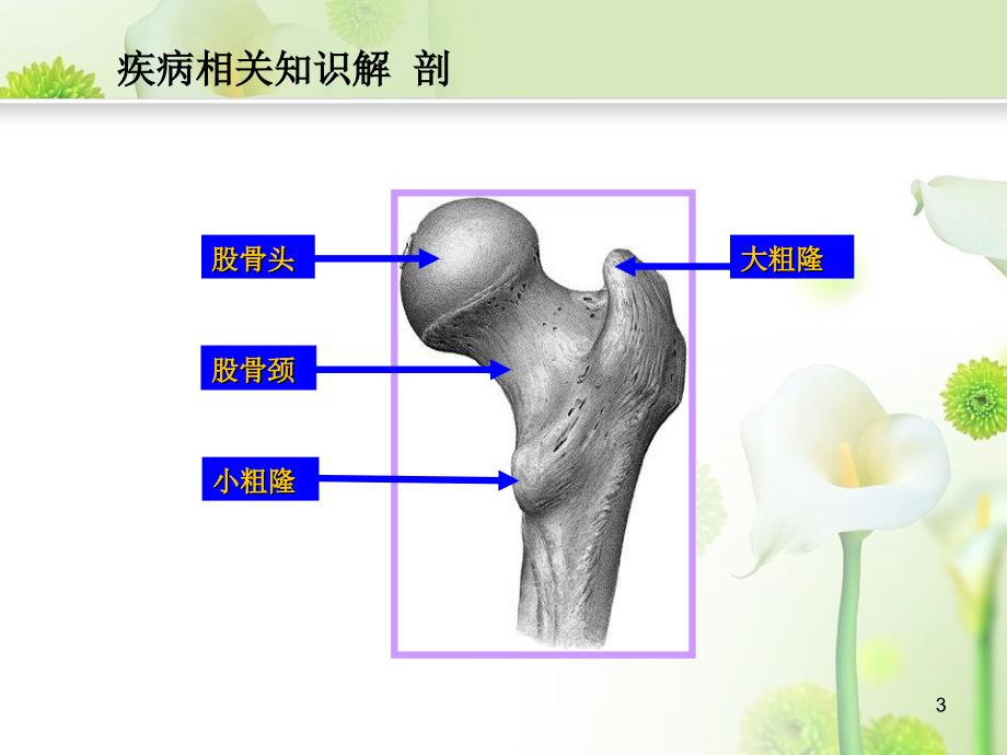 优质医学股骨粗隆间骨折护理查房_第3页