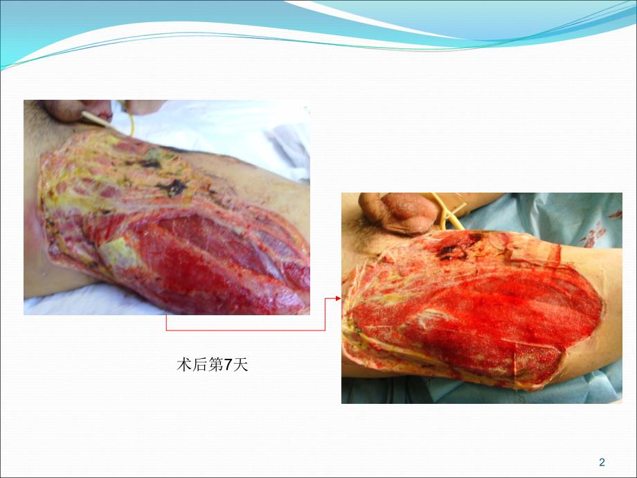 负压封闭引流技术ppt课件_第2页