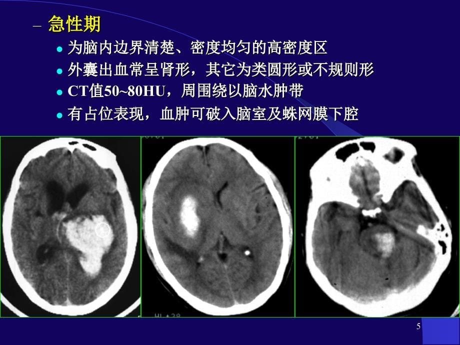 脑出血讲座培训课件_第5页