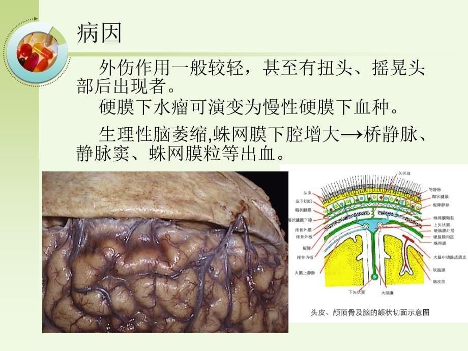 慢性硬膜下血肿PPT优秀课件_第5页