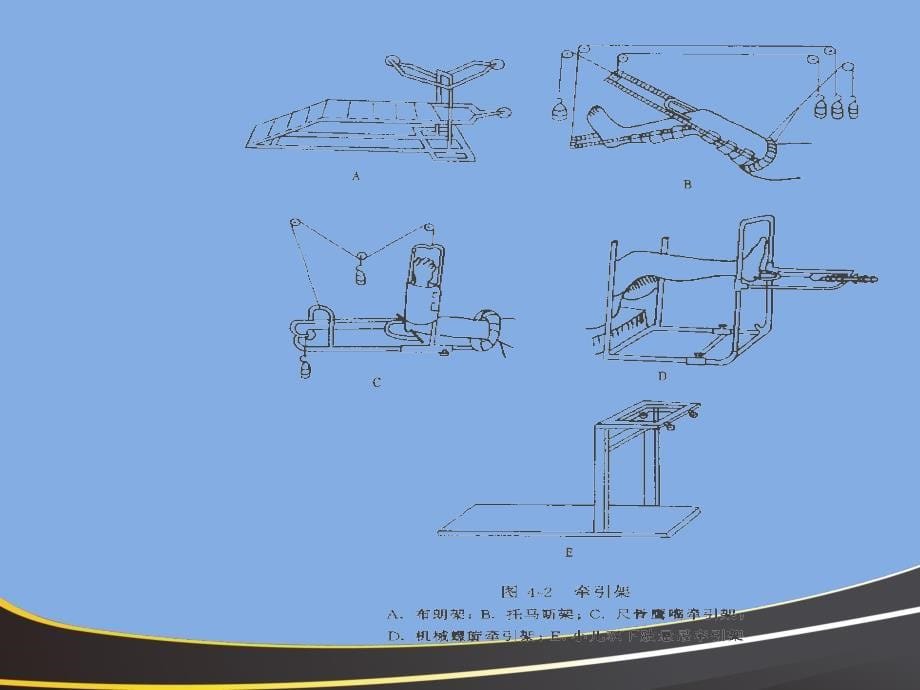 常见骨折牵引疗法及骨折并发症防治_第5页
