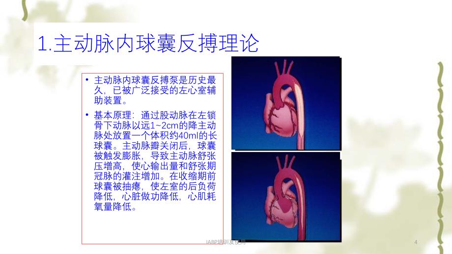IABP培训及使用ppt课件_第4页