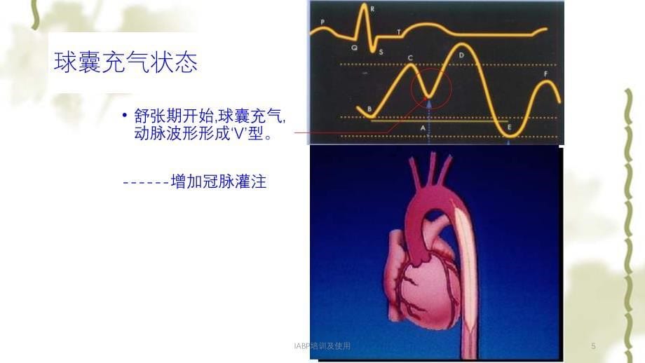 IABP培训及使用ppt课件_第5页
