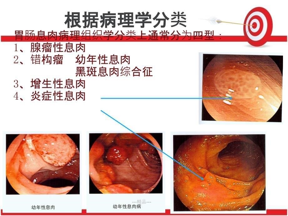 内镜下EMR术的配合要点课件_第5页