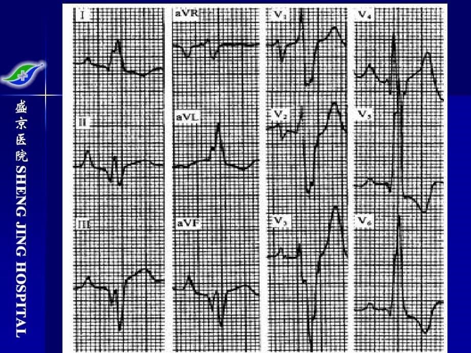 急性心肌梗死样心电图的鉴别课件_第5页
