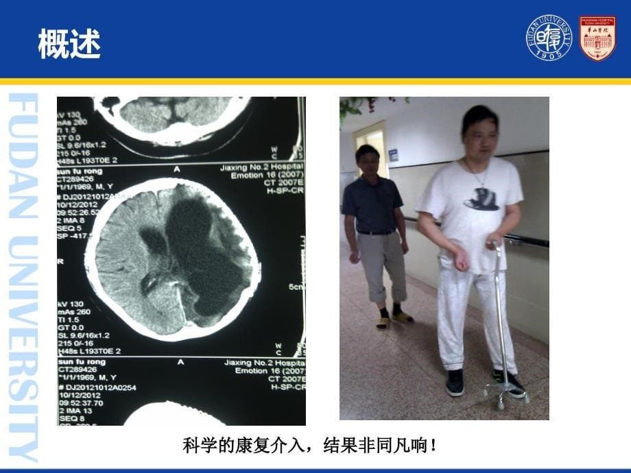 康复医学：08 颅脑外伤的康复_第5页