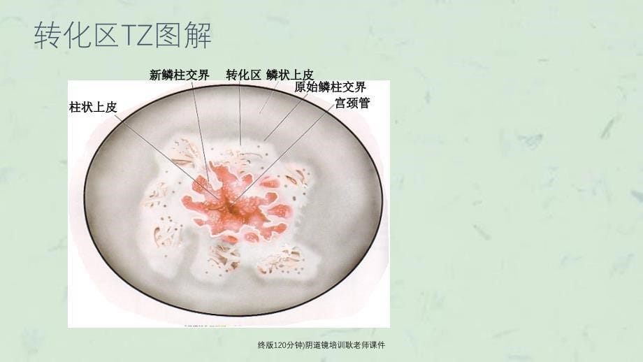 终版120分钟)阴道镜培训耿老师课件_第5页