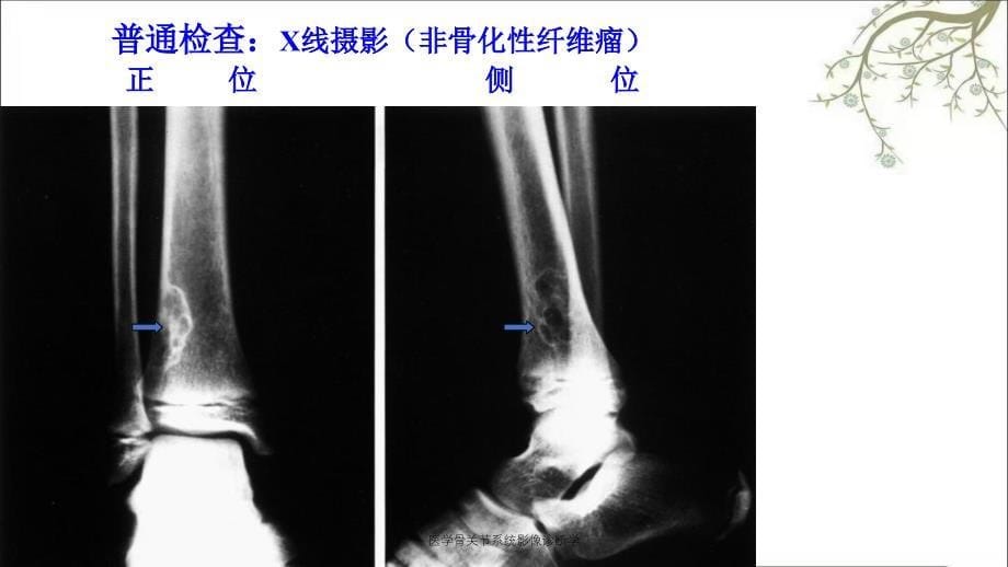 医学骨关节系统影像诊断学_第5页