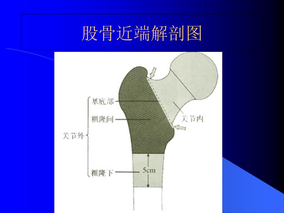 股骨粗隆间骨折课件_第3页