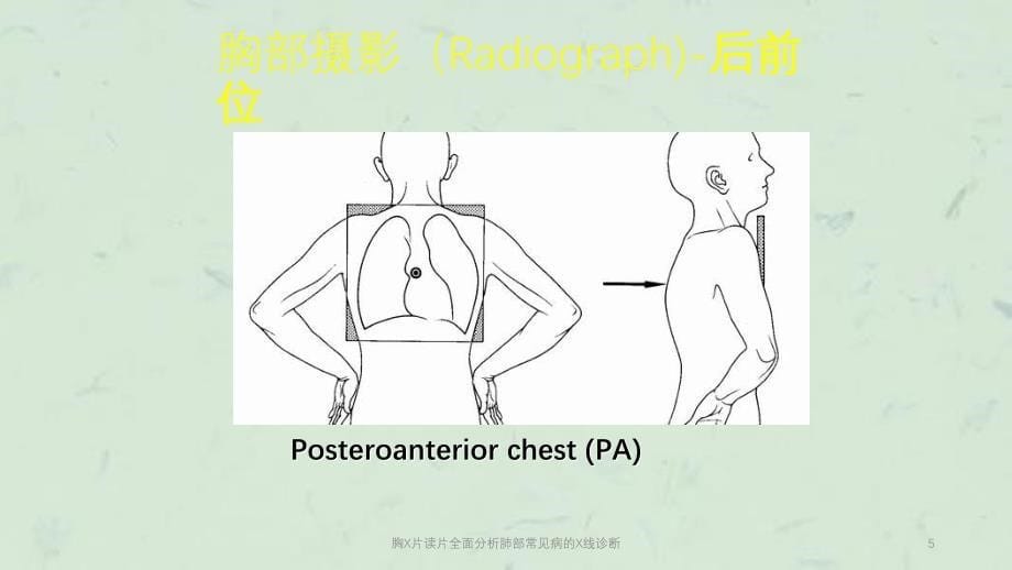 胸X片读片全面分析肺部常见病的X线诊断课件_第5页