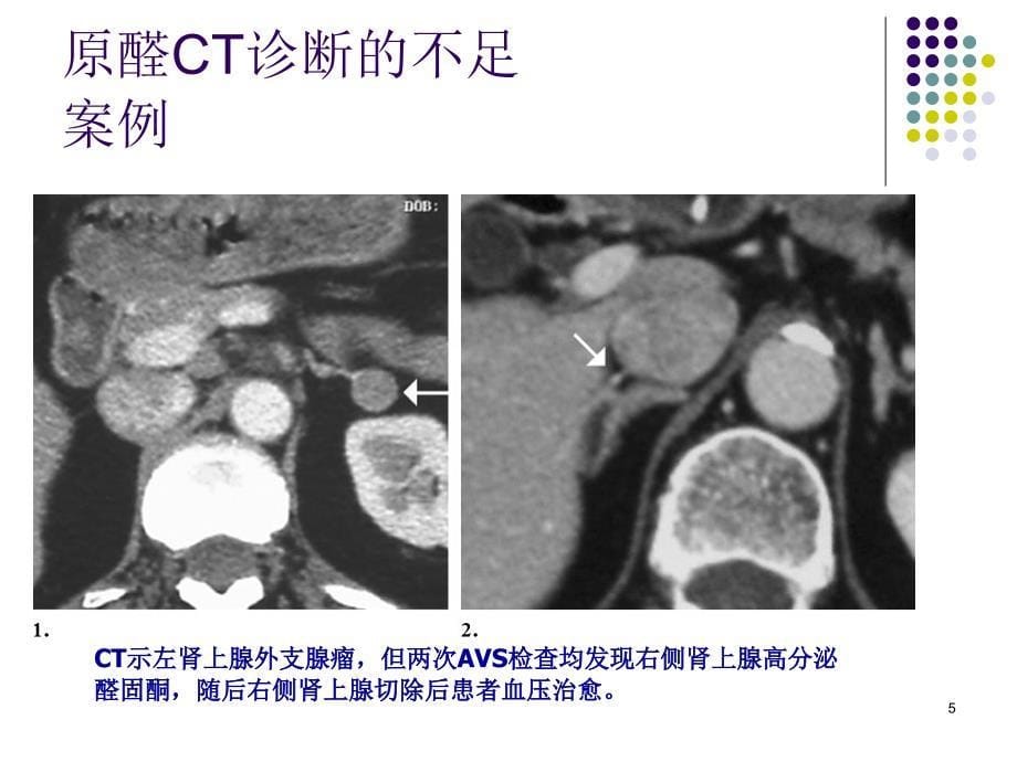 医学课件分侧肾上腺静脉取_第5页