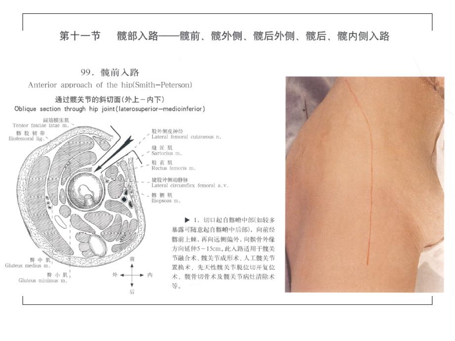 髋关节手术入路ppt课件_第2页