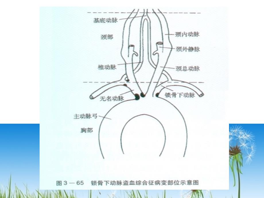 锁骨下动脉盗血综合征(幻灯片)_第3页