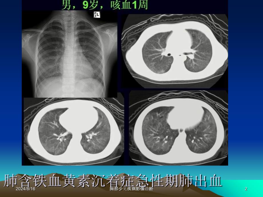 胸部少见疾病影像诊断课件_第2页