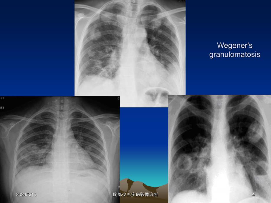 胸部少见疾病影像诊断课件_第4页