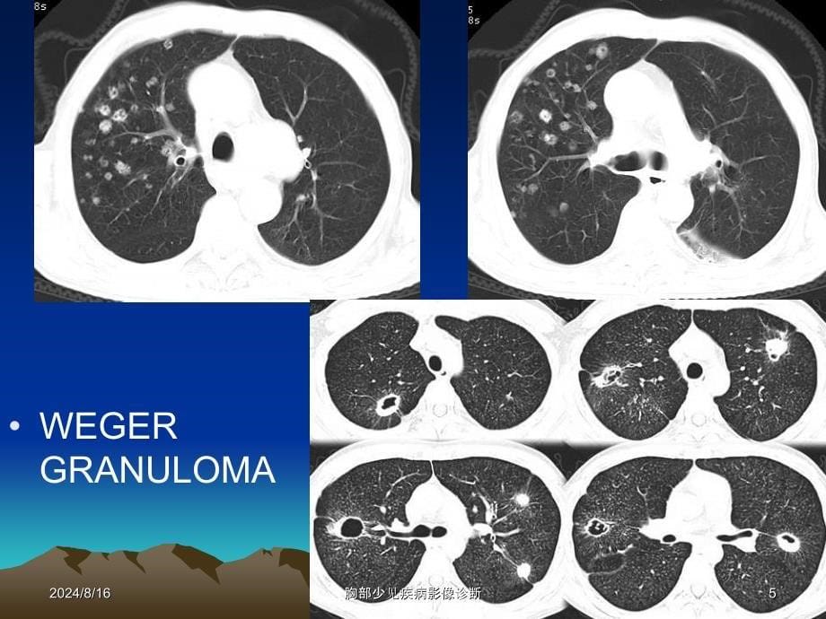 胸部少见疾病影像诊断课件_第5页