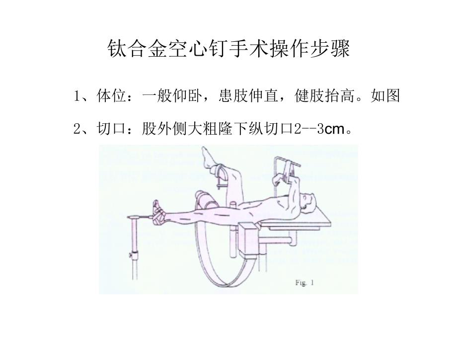 钛合金空心钉手术操作步骤_第1页