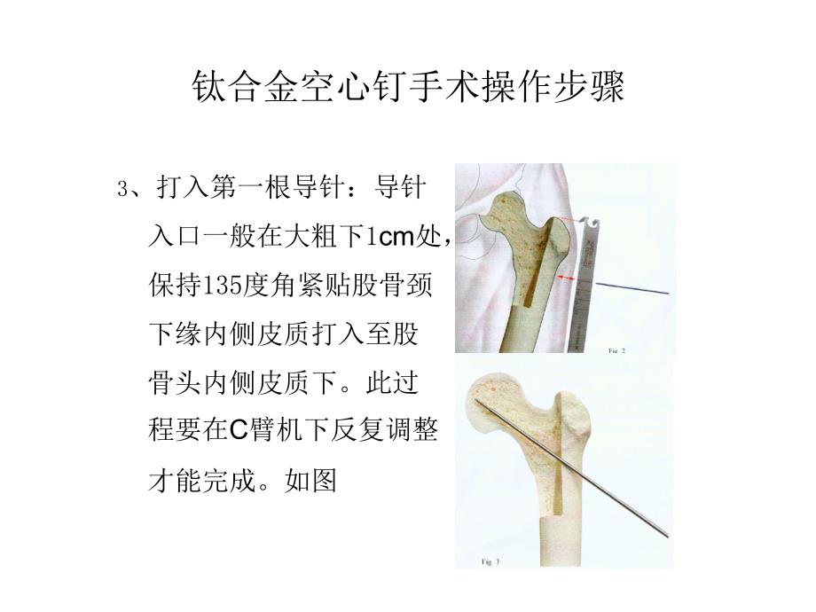 钛合金空心钉手术操作步骤_第2页