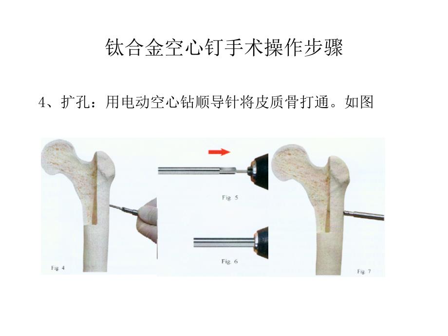 钛合金空心钉手术操作步骤_第3页