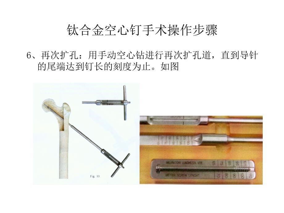 钛合金空心钉手术操作步骤_第5页