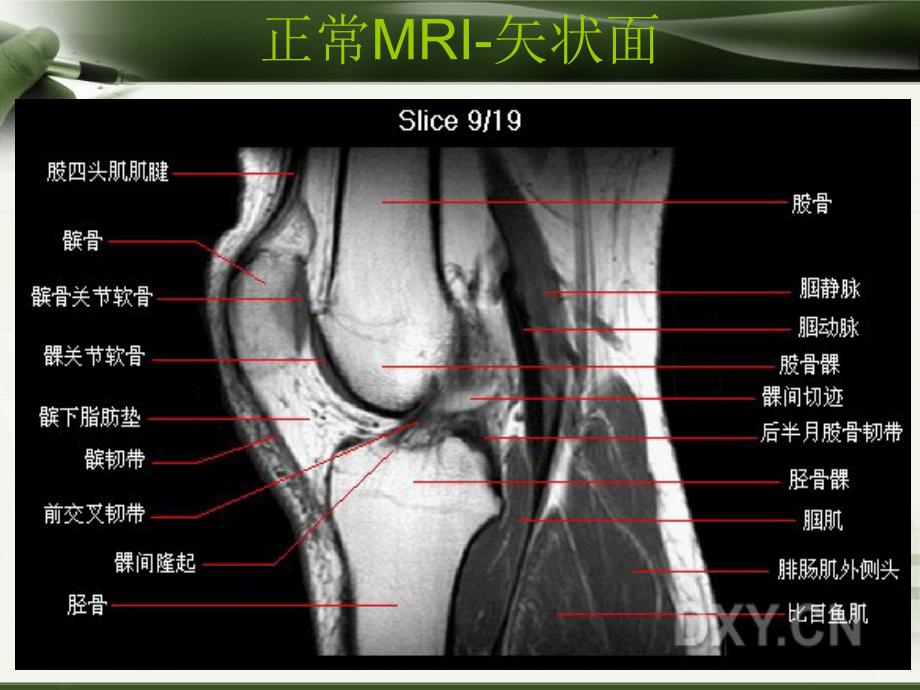 膝关节MRI诊断_第3页