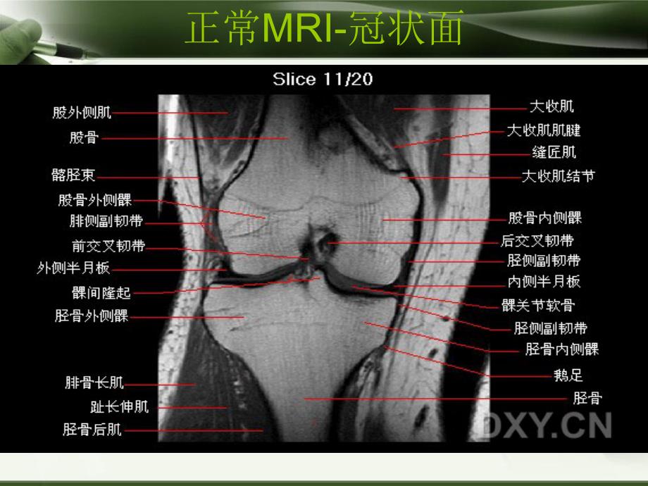 膝关节MRI诊断_第4页