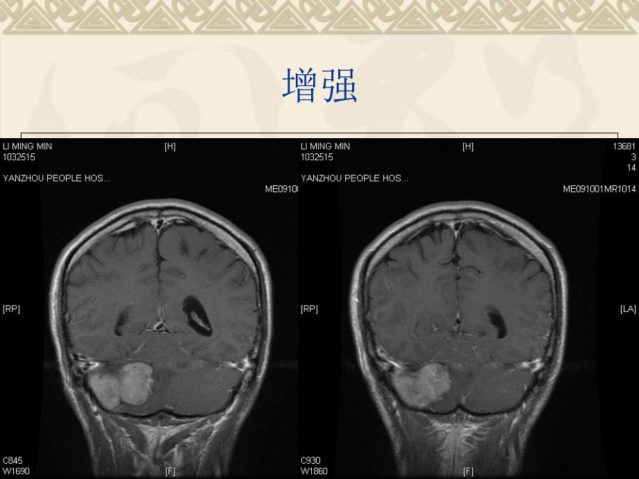 总结D在颅脑疾病诊断中的应用 (下)_第1页