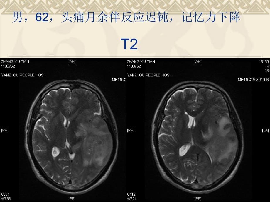 总结D在颅脑疾病诊断中的应用 (下)_第5页