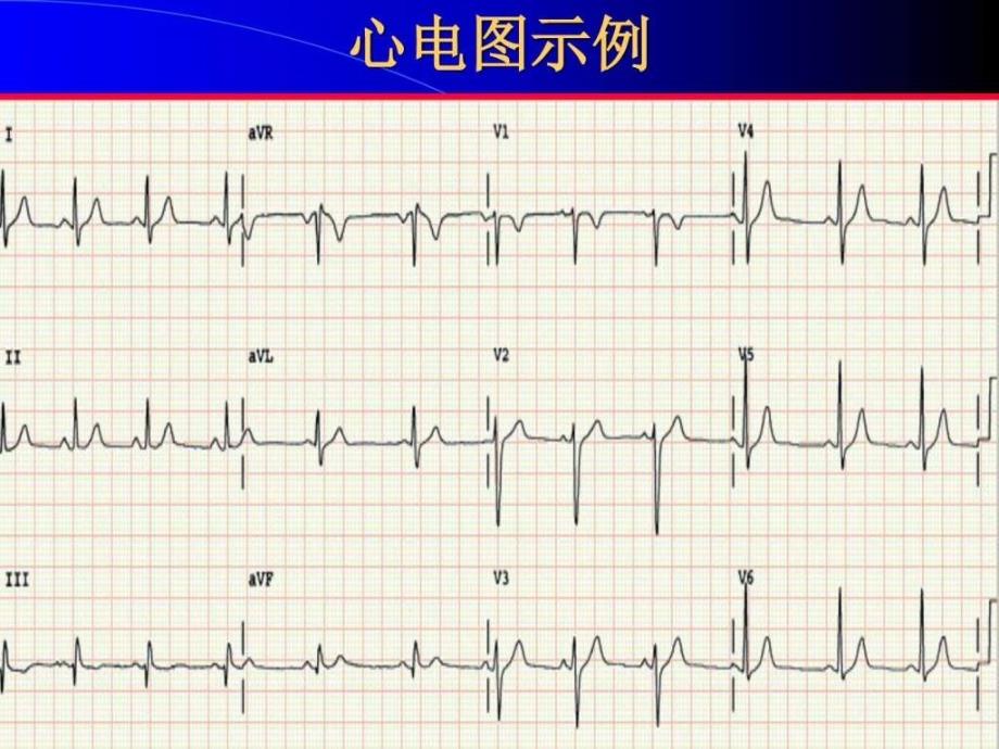 临床心电学基本知识课件_第4页