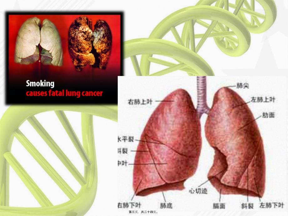 2022年医学专题—左上肺癌根治术_第3页