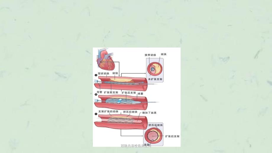 冠脉内溶栓临床应用课件_第3页