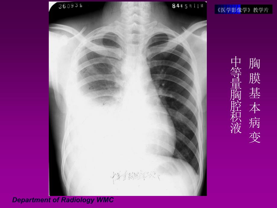 《医学影像学》实验课件：呼吸系统-2_第3页