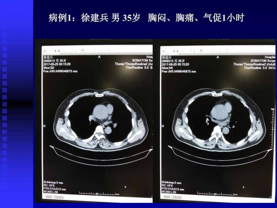 主动脉夹层影像学诊断_第1页