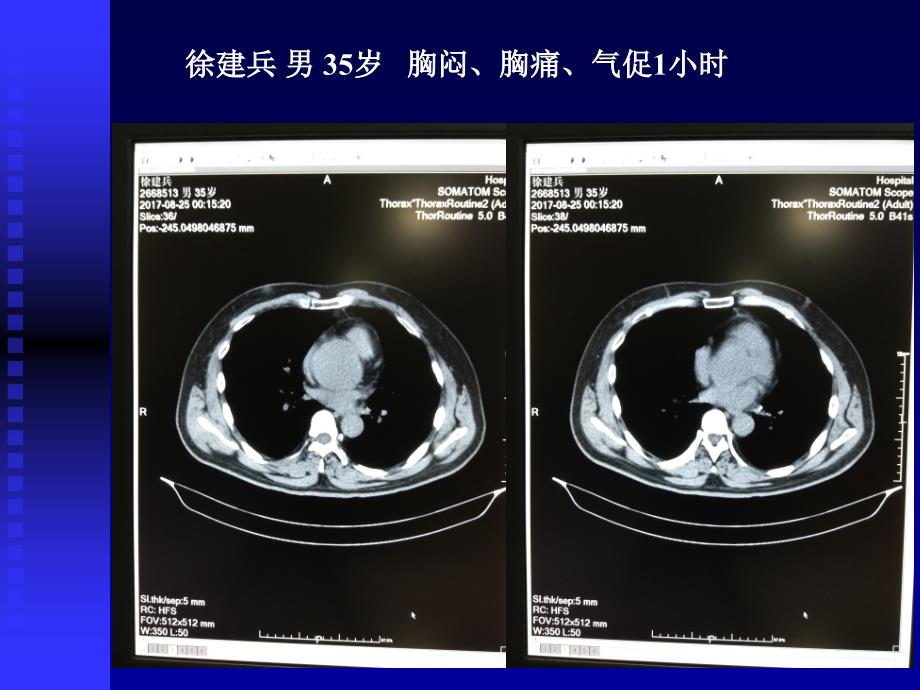 主动脉夹层影像学诊断_第2页