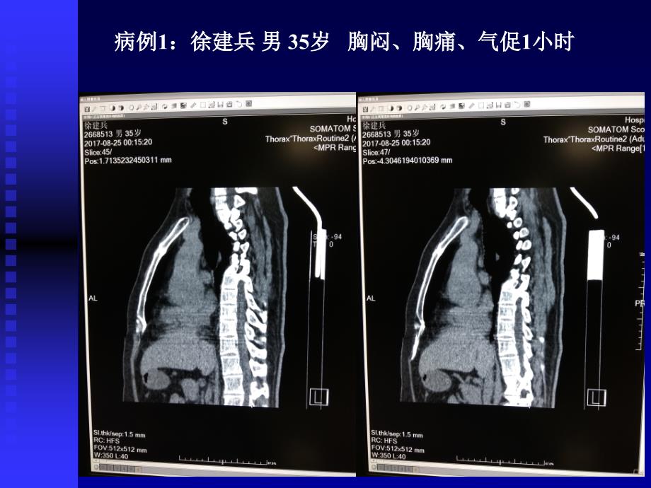 主动脉夹层影像学诊断_第4页