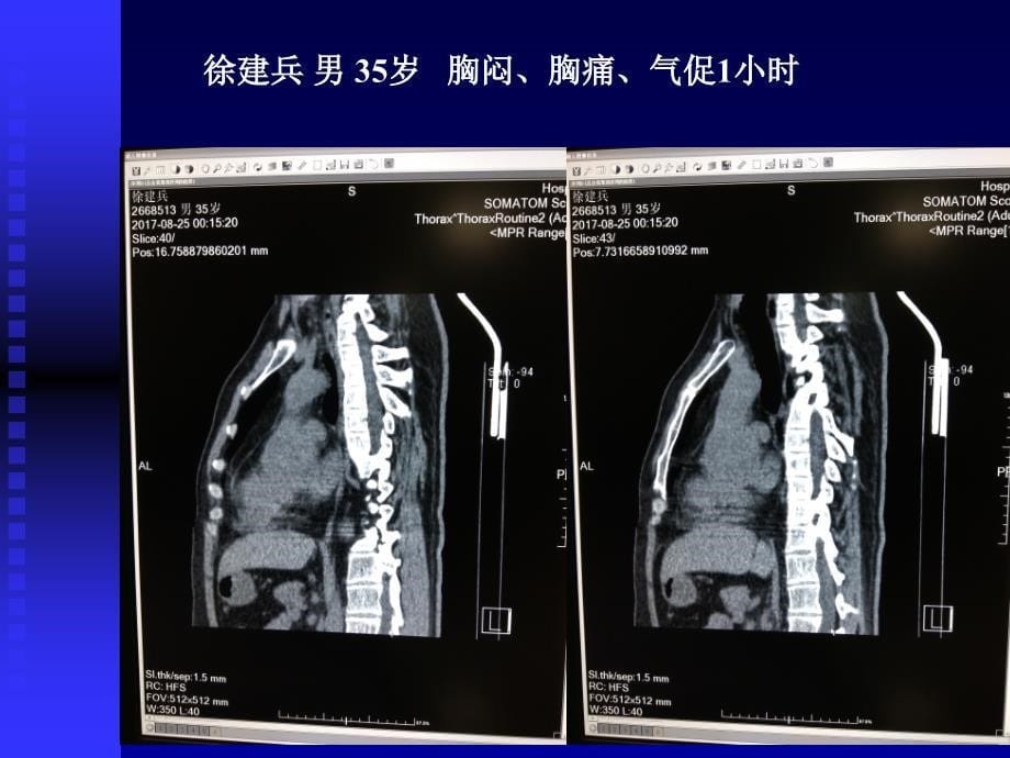 主动脉夹层影像学诊断_第5页